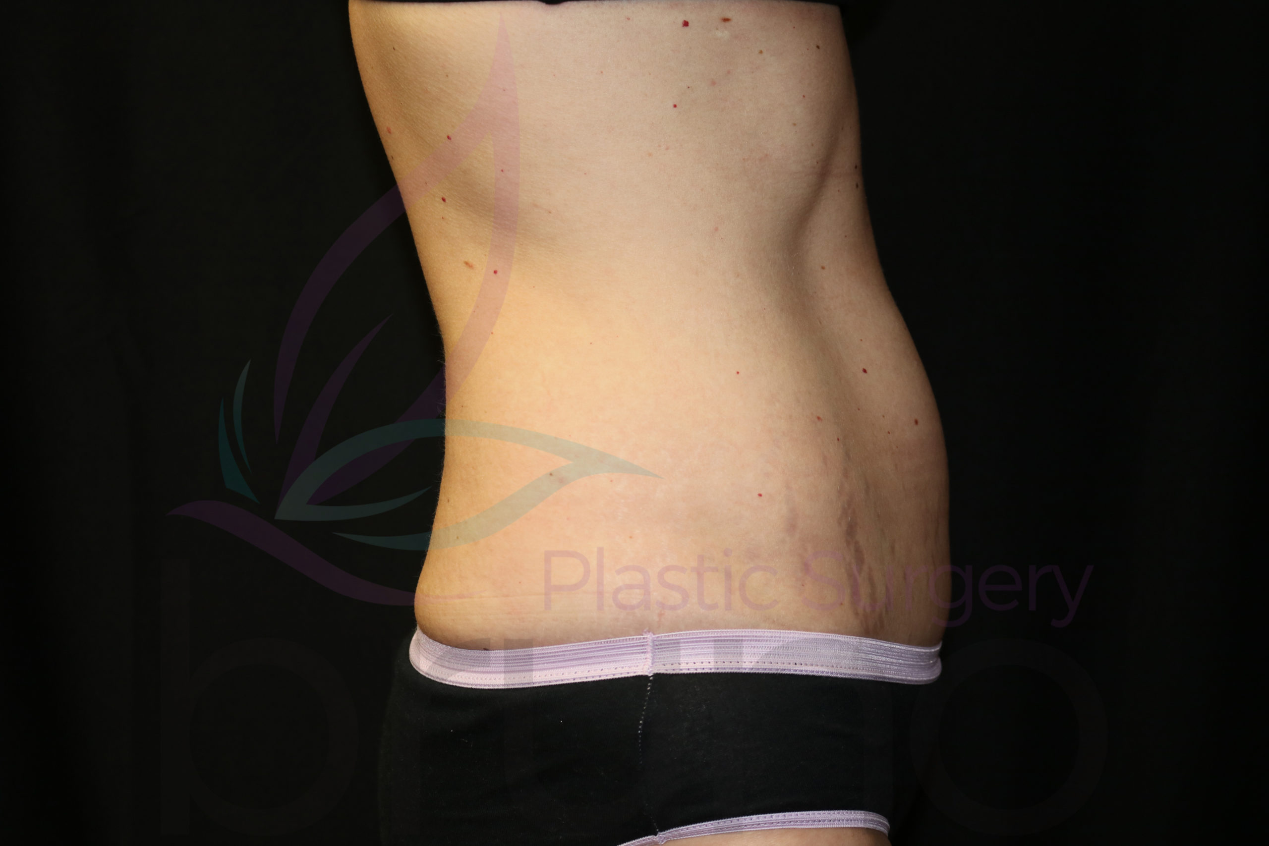 CoolSculpting4SideAfter