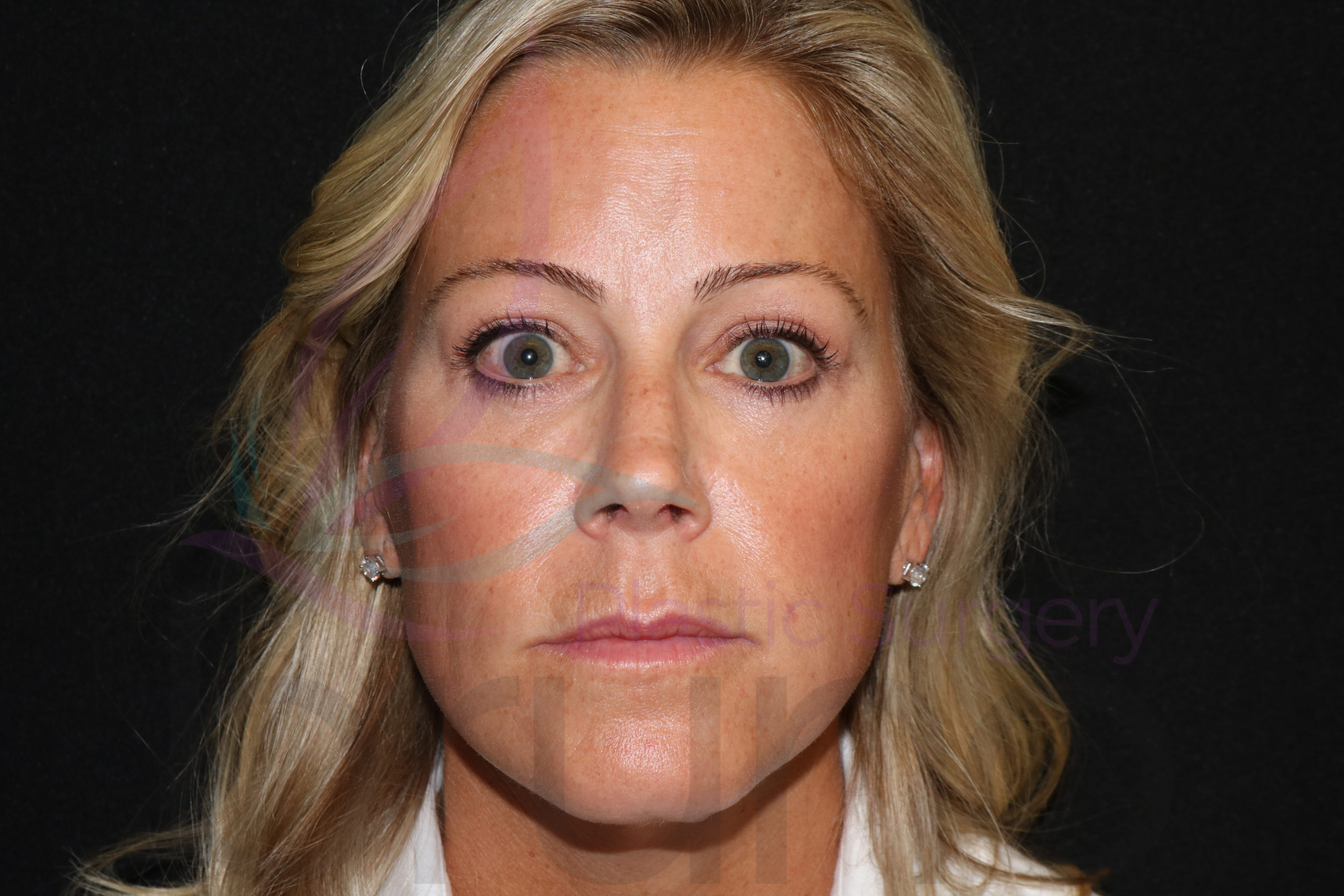 BrowLift&LowerBlepharoplasty1After