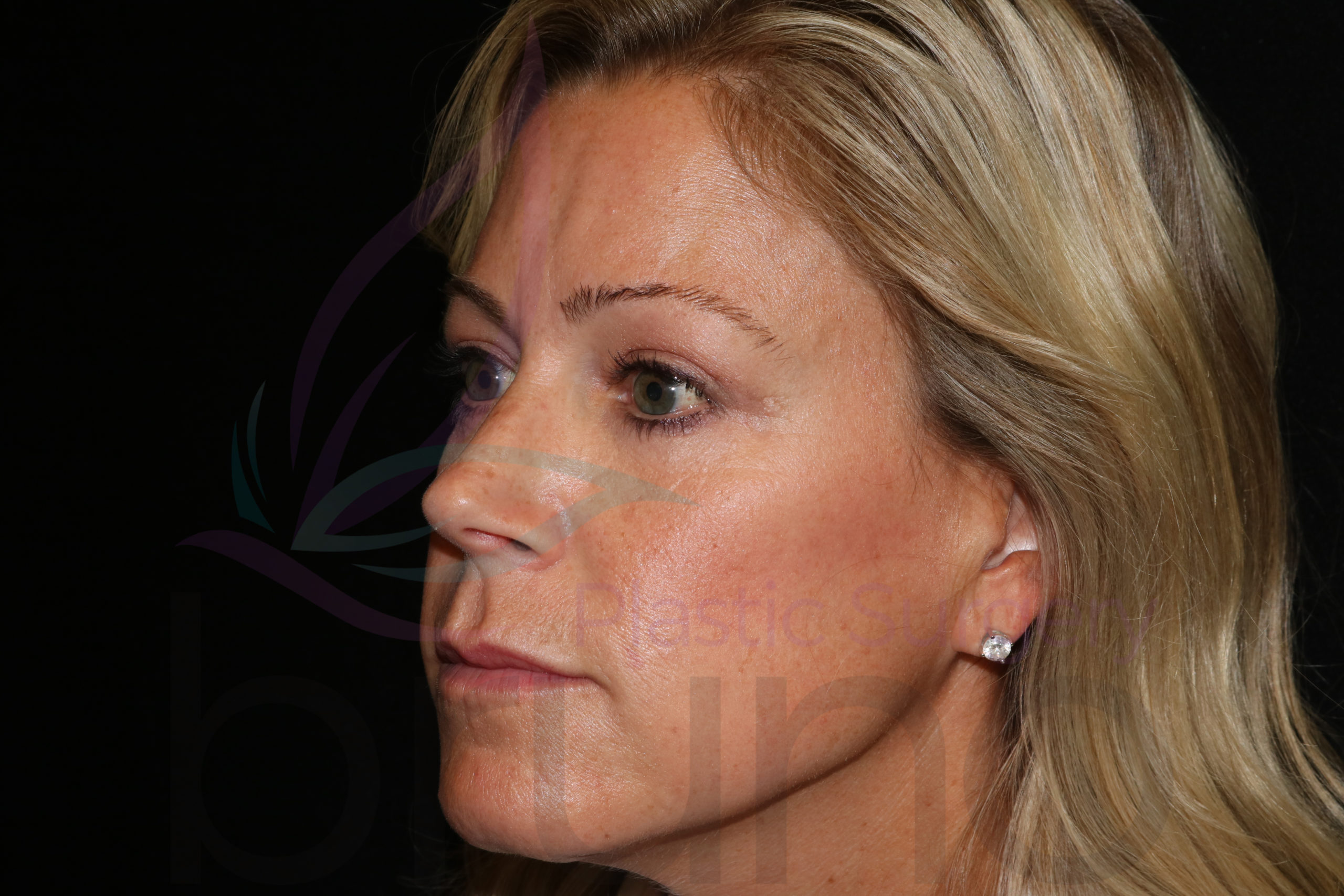 BrowLift&LowerBlepharoplasty12After