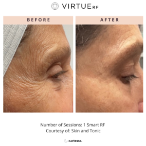 Photos of a woman’s forehead before and after VirtueRF microneedling treatment